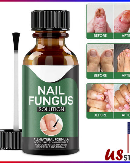 Anti Fungal Nail Treatment Nail Finger Toe Fungus Onychomycosis Remover - Vibes Harmony